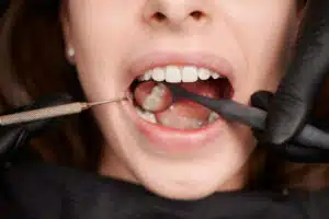 Teeth Problems After Pregnancy